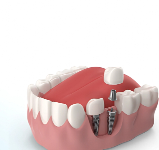 Teeth with visible metal screws