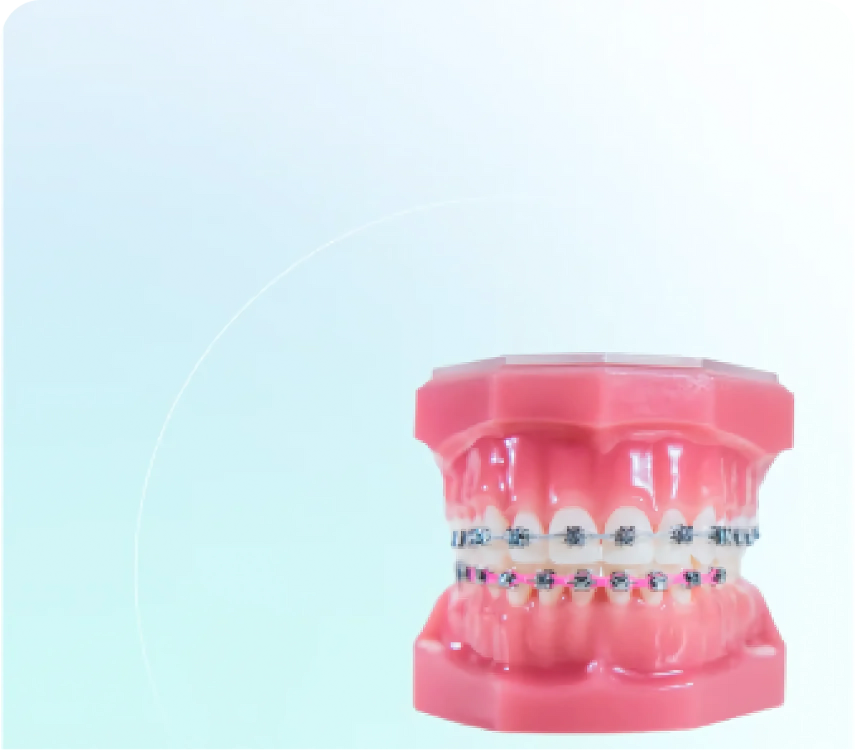 Dental model with metal braces fitted on artificial teeth